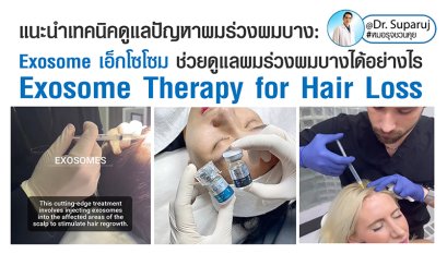 แนะนำเทคนิคดูแลปัญหาผมร่วงผมบาง: Exosome เอ็กโซโซม ช่วยดูแลผมร่วงผมบางได้อย่างไร Exosome Therapy for Hair Loss